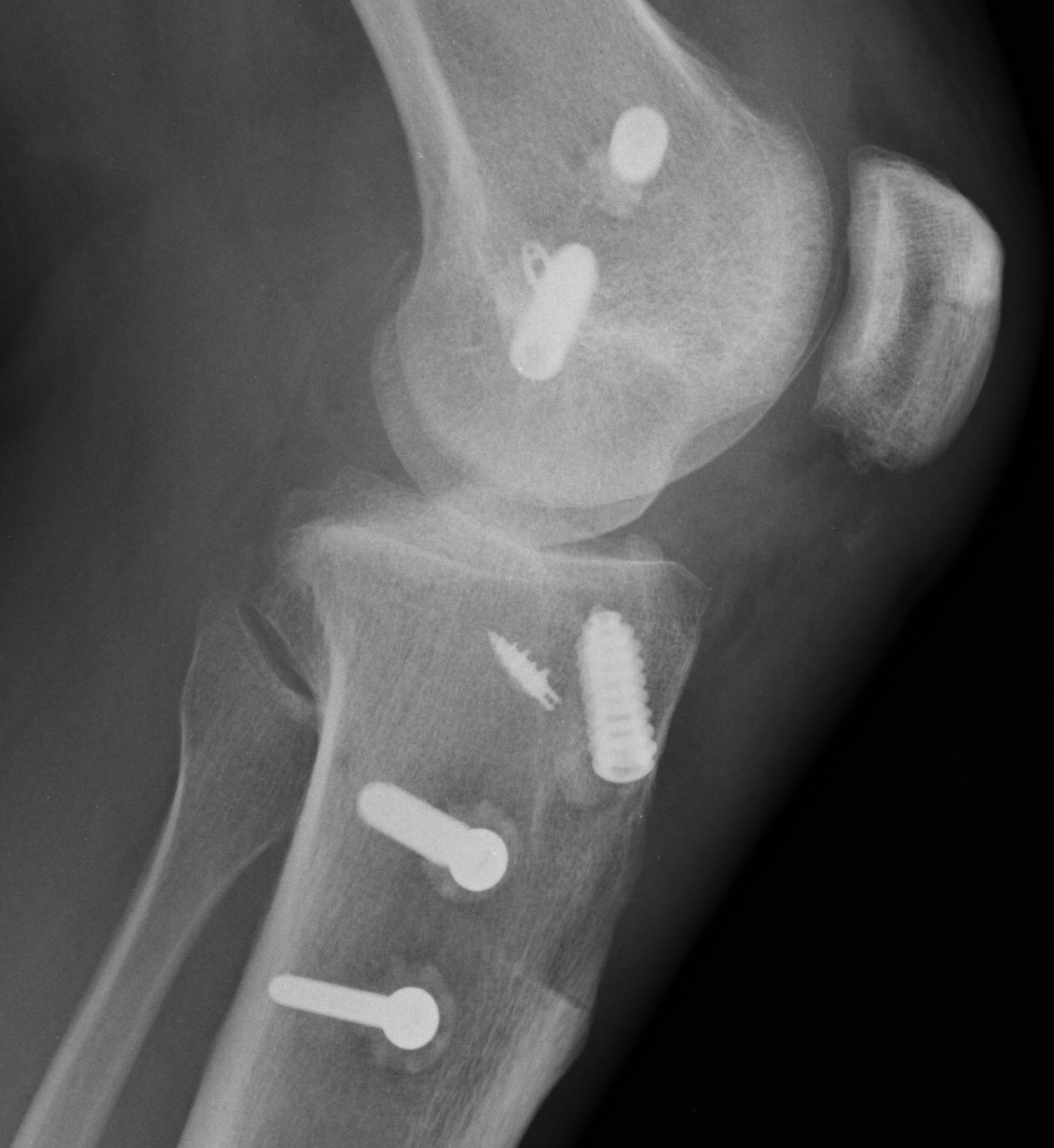 MCL Reconstruction tendoachilles allograft